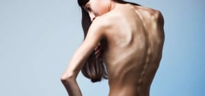 Anoressia nervosa - Psichiatra Roma